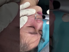 دستگاه لیزر 1064nm 532nm سالن Picosecond برای درمان مشکل ضایعات پیگمانتاسیون پوست